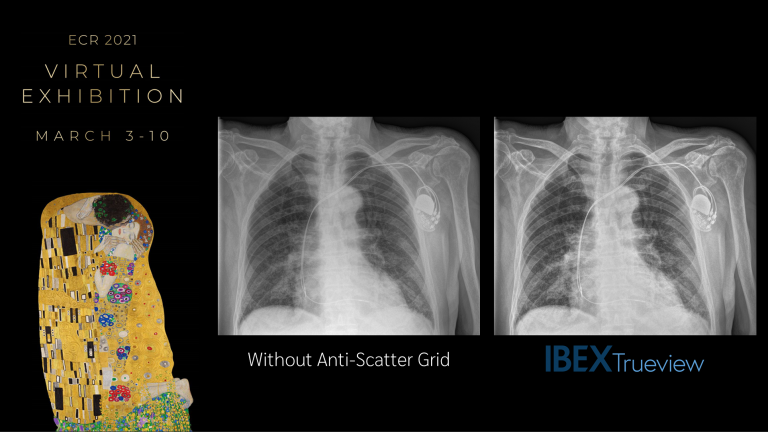 IBEX showcases state-of-the-art scatter correction and bone classification products at ECR 2021