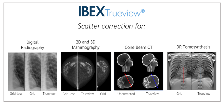 RSNA Showcase – IBEX Trueview® Unrivalled Scatter Removal